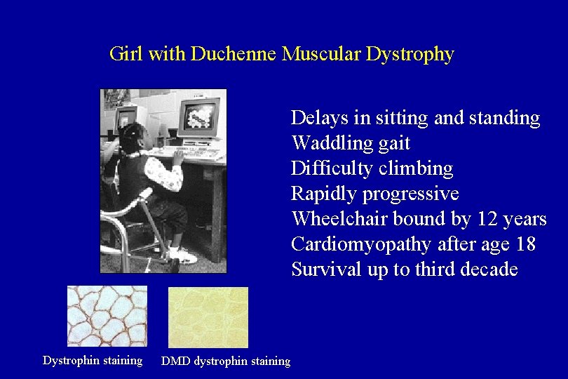 Girl with Duchenne Muscular Dystrophy Delays in sitting and standing Waddling gait Difficulty climbing