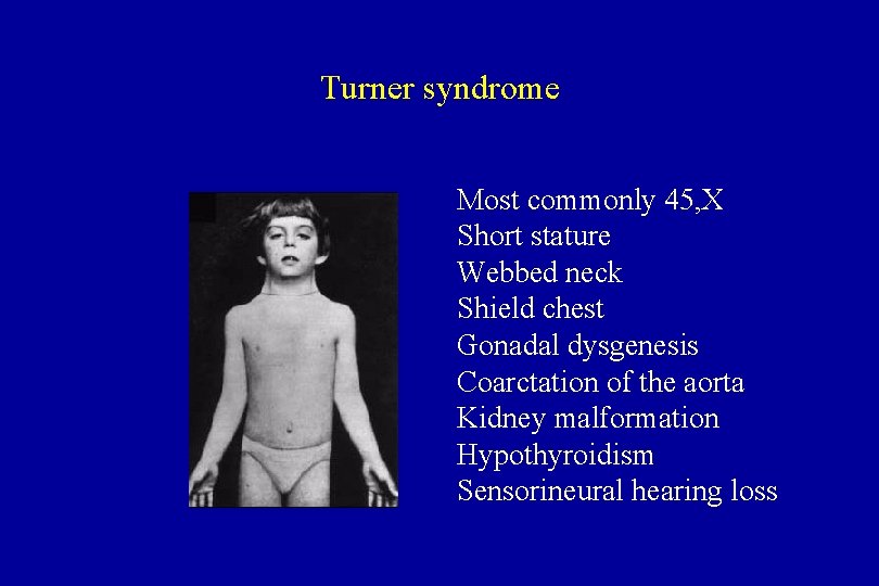 Turner syndrome Most commonly 45, X Short stature Webbed neck Shield chest Gonadal dysgenesis