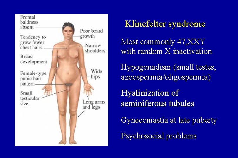 Klinefelter syndrome Most commonly 47, XXY with random X inactivation Hypogonadism (small testes, azoospermia/oligospermia)