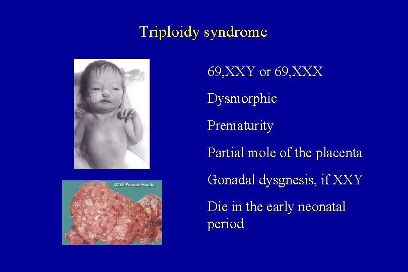 Triploidy syndrome 69, XXY or 69, XXX Dysmorphic Prematurity Partial mole of the placenta