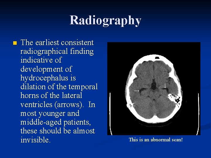 Radiography n The earliest consistent radiographical finding indicative of development of hydrocephalus is dilation
