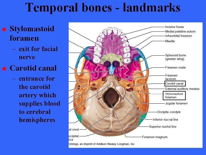 Temporal bones - landmarks n Stylomastoid foramen – exit for facial nerve n Carotid