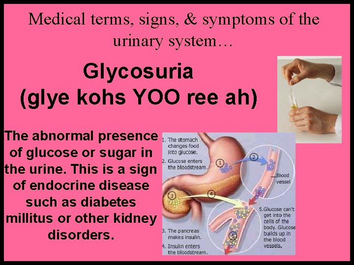 Medical terms, signs, & symptoms of the urinary system… Glycosuria (glye kohs YOO ree