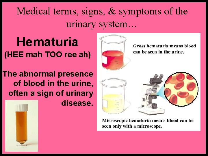 Medical terms, signs, & symptoms of the urinary system… Hematuria (HEE mah TOO ree