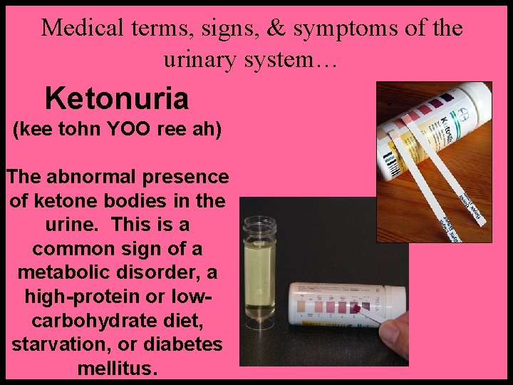 Medical terms, signs, & symptoms of the urinary system… Ketonuria (kee tohn YOO ree