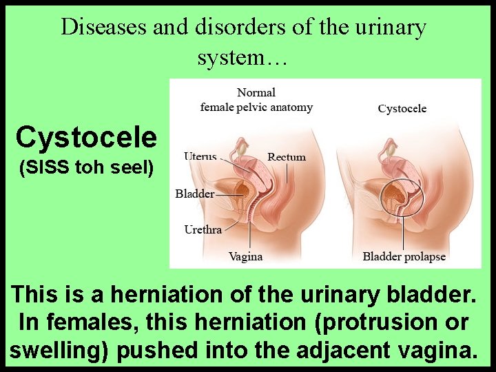 Diseases and disorders of the urinary system… Cystocele (SISS toh seel) This is a