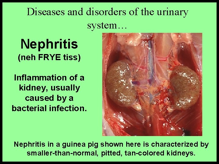 Diseases and disorders of the urinary system… Nephritis (neh FRYE tiss) Inflammation of a