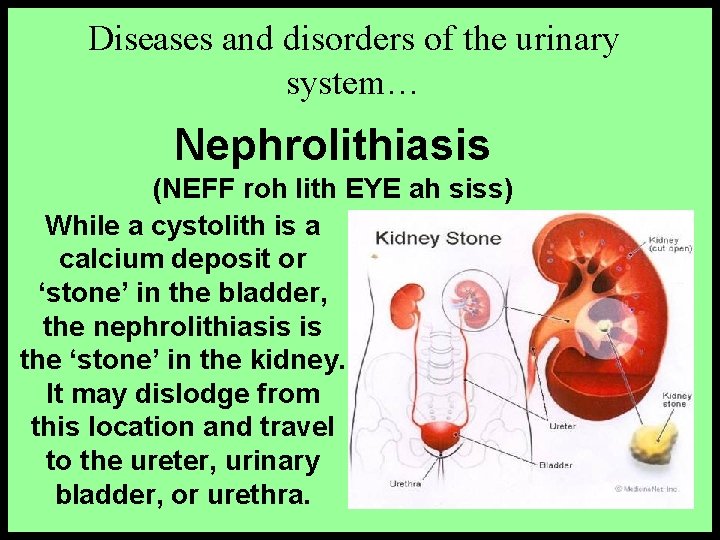 Diseases and disorders of the urinary system… Nephrolithiasis (NEFF roh lith EYE ah siss)