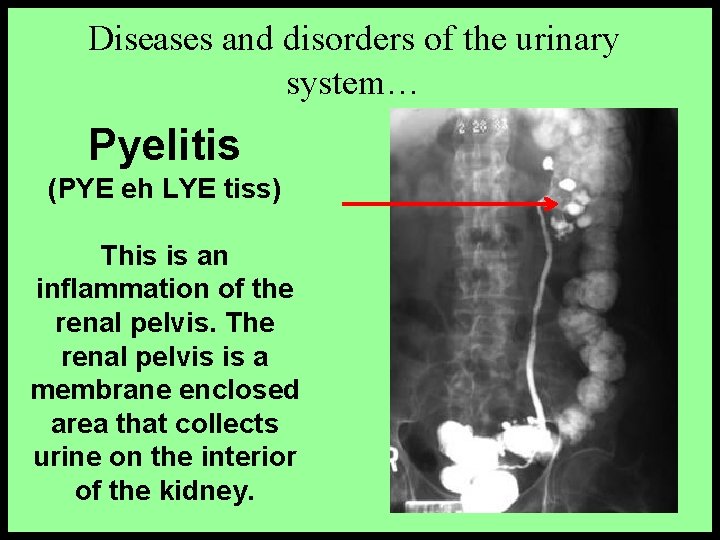 Diseases and disorders of the urinary system… Pyelitis (PYE eh LYE tiss) This is