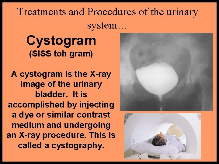 Treatments and Procedures of the urinary system… Cystogram (SISS toh gram) A cystogram is