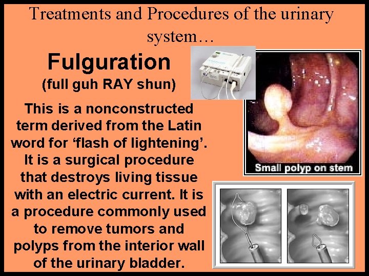 Treatments and Procedures of the urinary system… Fulguration (full guh RAY shun) This is