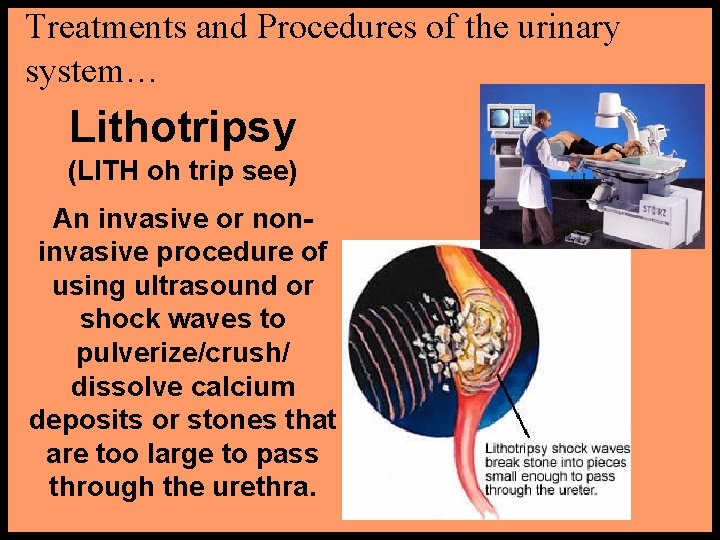 Treatments and Procedures of the urinary system… Lithotripsy (LITH oh trip see) An invasive