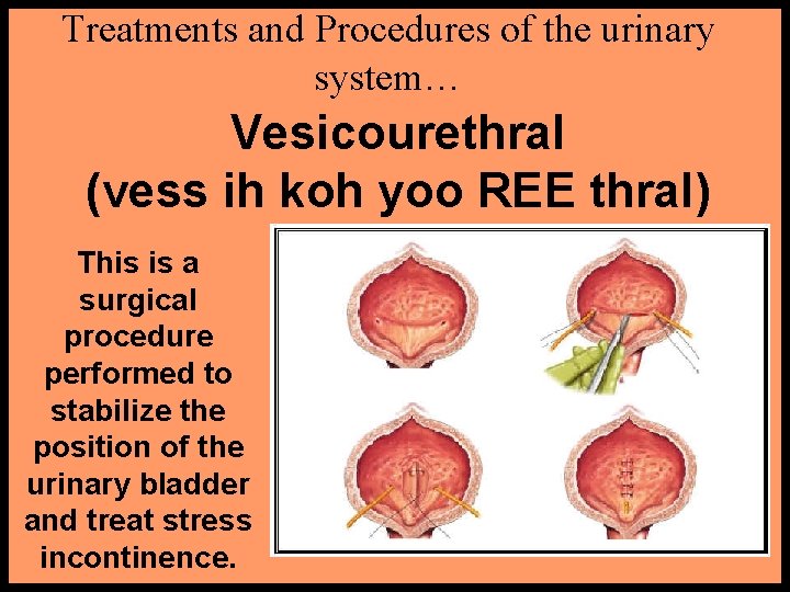 Treatments and Procedures of the urinary system… Vesicourethral (vess ih koh yoo REE thral)