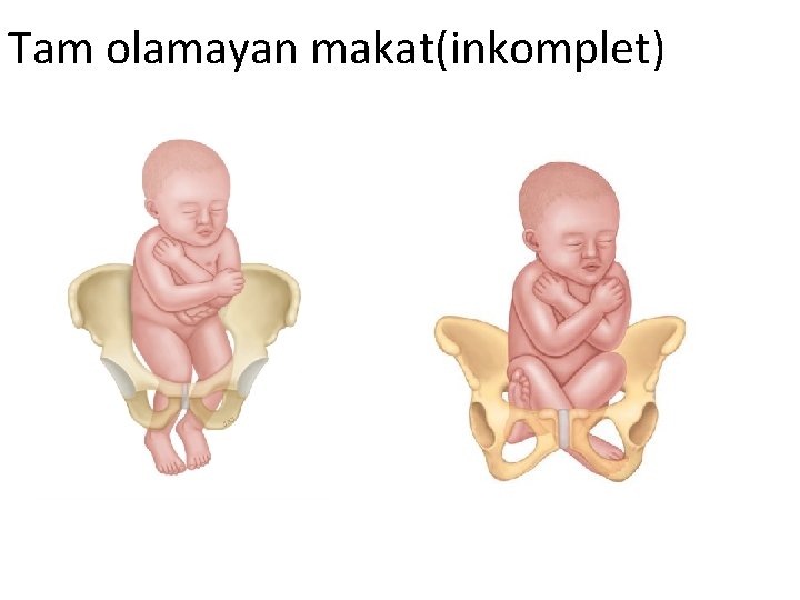 Tam olamayan makat(inkomplet) 