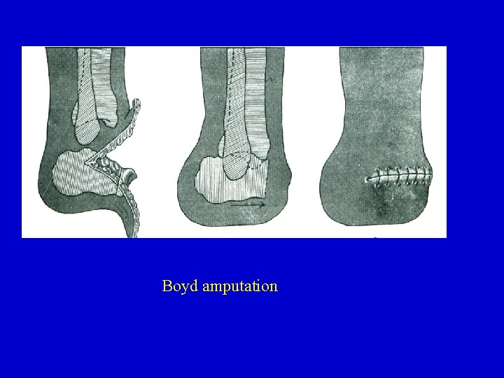 Boyd amputation 