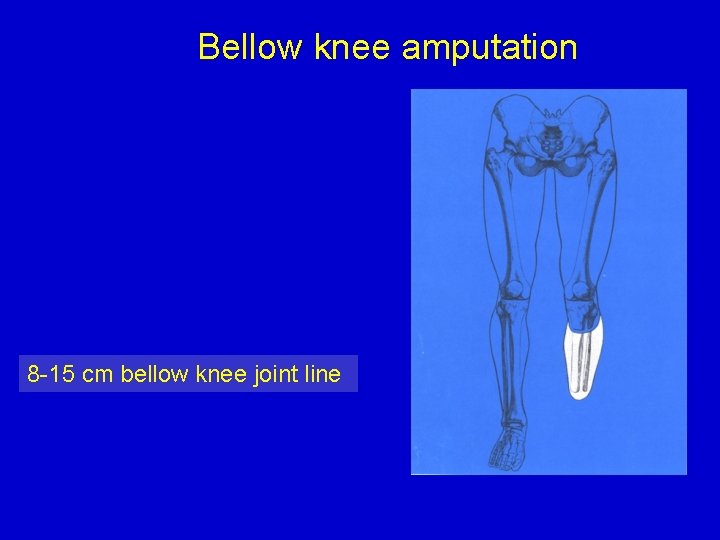 Bellow knee amputation 8 -15 cm bellow knee joint line 