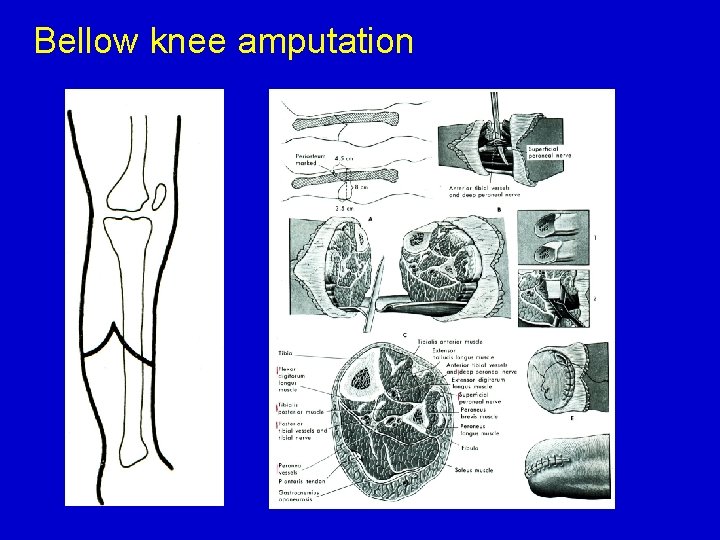 Bellow knee amputation 