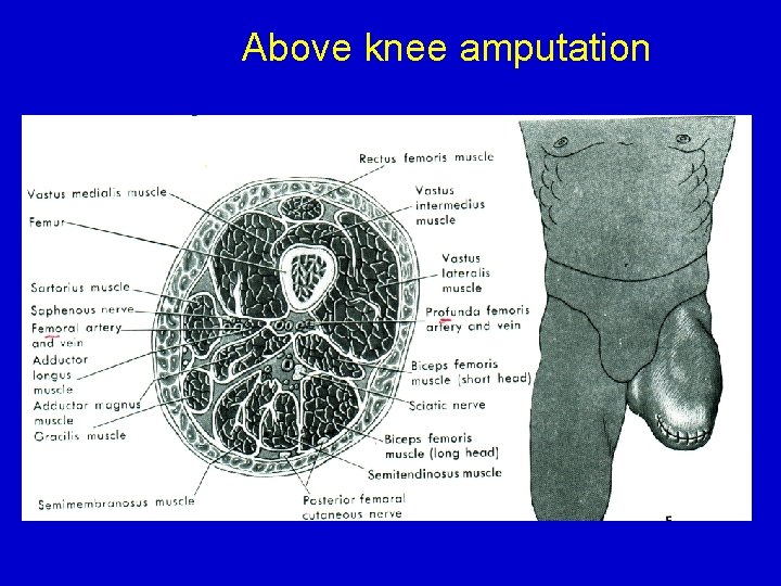 Above knee amputation 