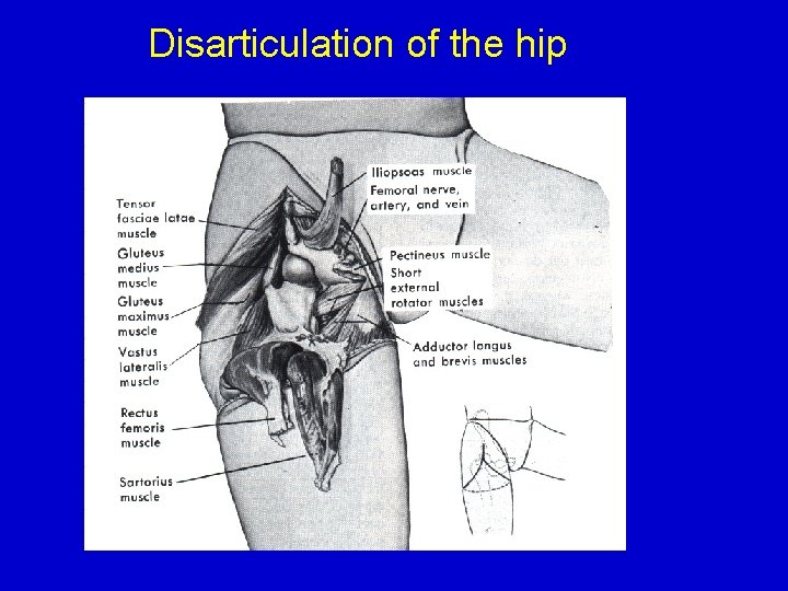Disarticulation of the hip 
