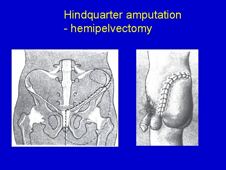 Hindquarter amputation - hemipelvectomy 