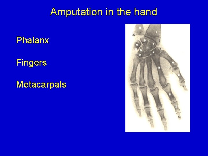 Amputation in the hand Phalanx Fingers Metacarpals 