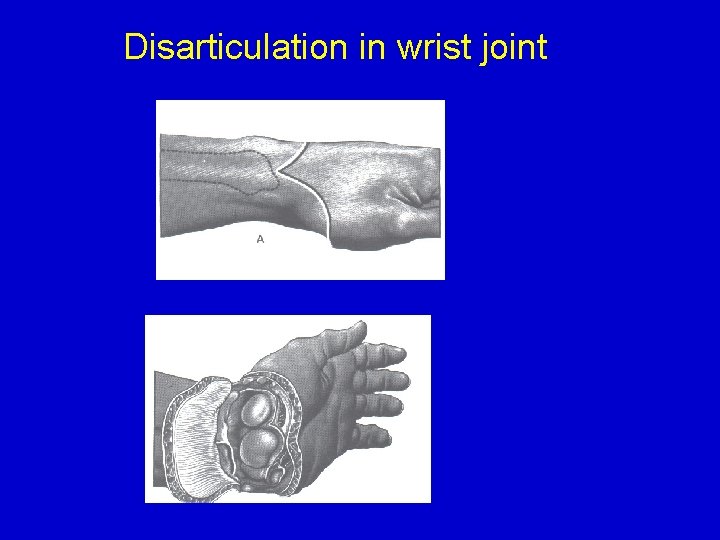 Disarticulation in wrist joint 