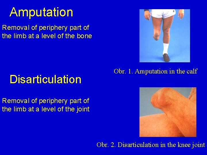 Amputation Removal of periphery part of the limb at a level of the bone