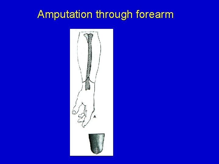 Amputation through forearm 