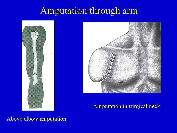 Amputation through arm Amputation in surgical neck Above elbow amputation 