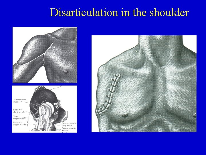 Disarticulation in the shoulder 