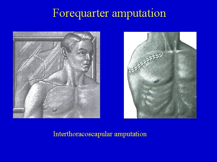 Forequarter amputation Interthoracoscapular amputation 