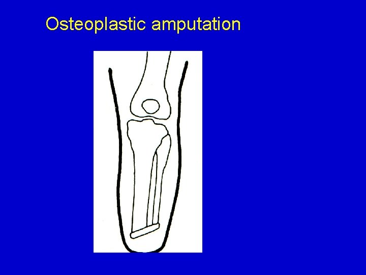 Osteoplastic amputation 