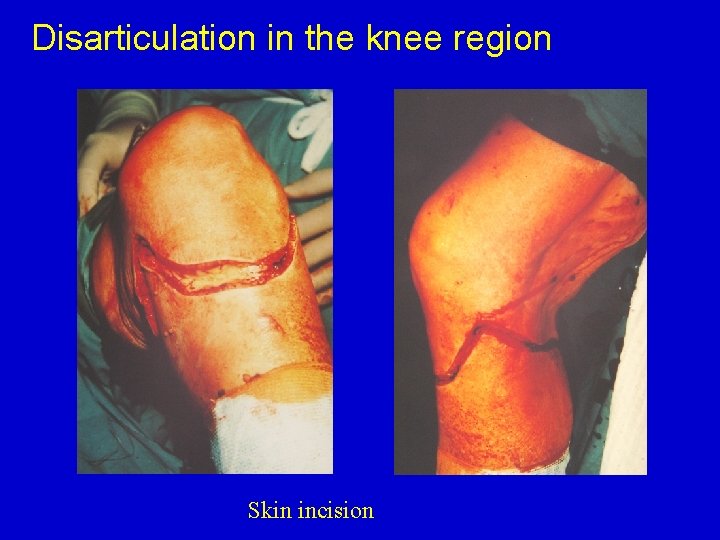 Disarticulation in the knee region Skin incision 