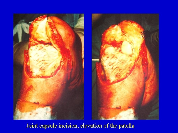 Joint capsule incision, elevation of the patella 