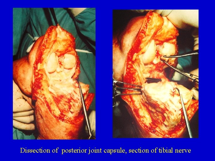 Dissection of posterior joint capsule, section of tibial nerve 