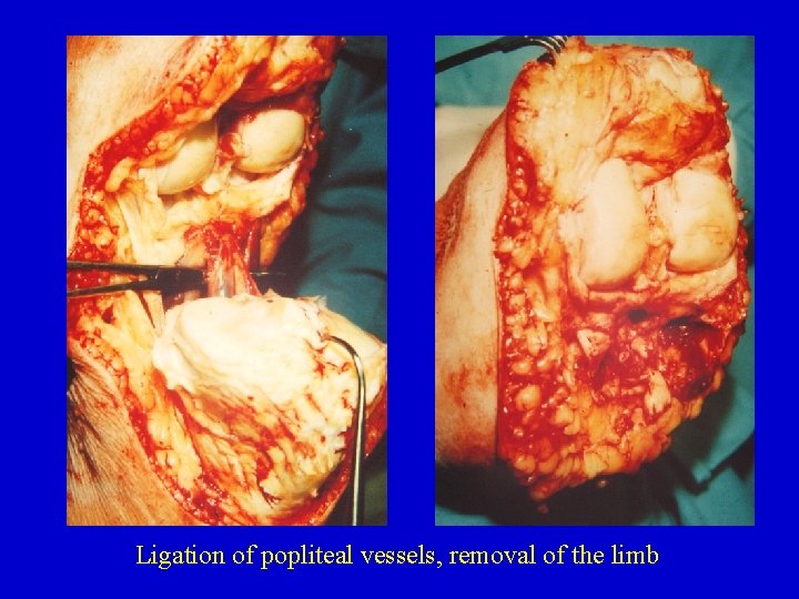 Ligation of popliteal vessels, removal of the limb 