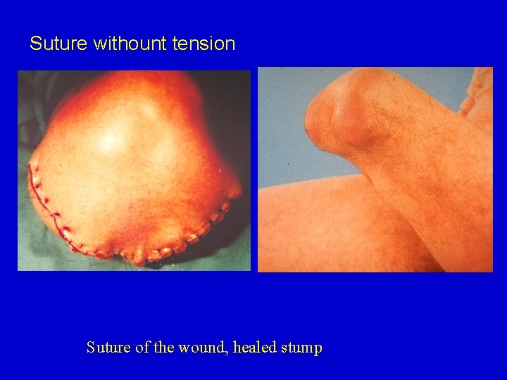 Suture withount tension Suture of the wound, healed stump 