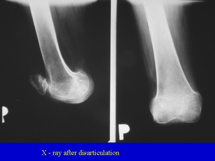 X - ray after disarticulation 