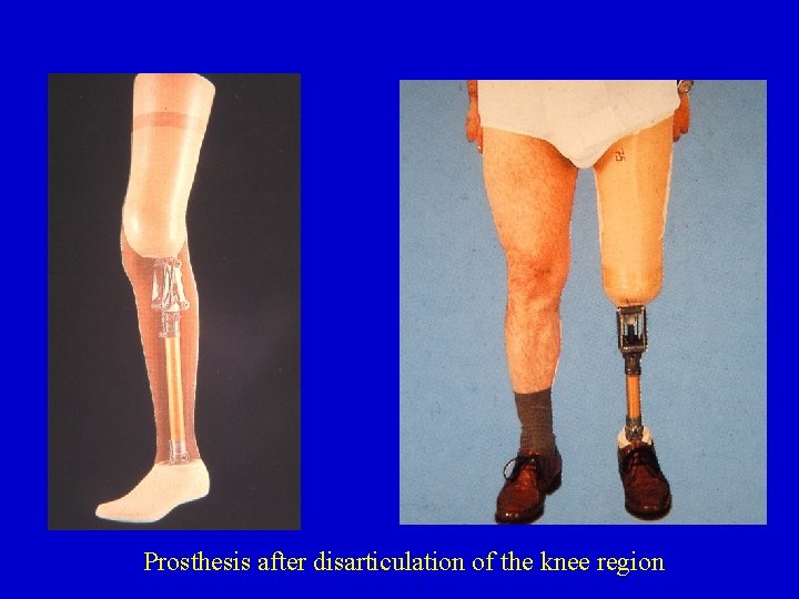 Prosthesis after disarticulation of the knee region 