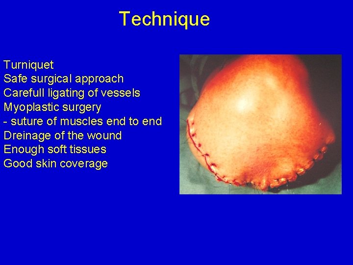 Technique Turniquet Safe surgical approach Carefull ligating of vessels Myoplastic surgery - suture of