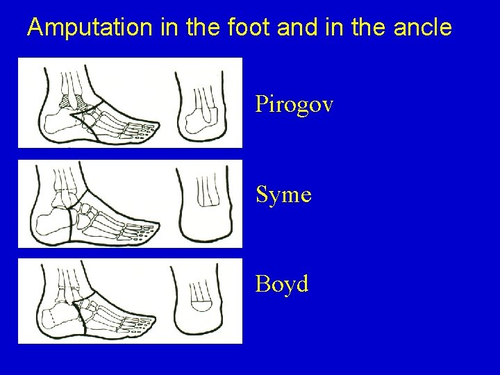 Amputation in the foot and in the ancle Pirogov Syme Boyd 