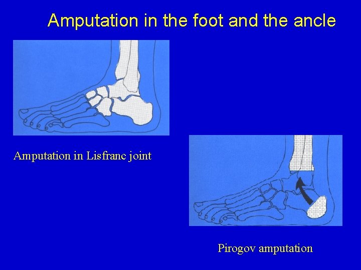 Amputation in the foot and the ancle Amputation in Lisfranc joint Pirogov amputation 