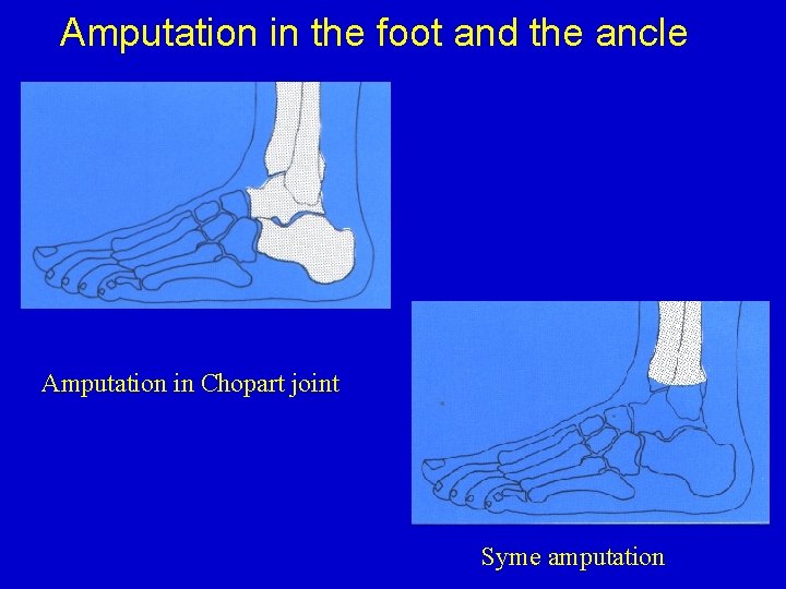 Amputation in the foot and the ancle Amputation in Chopart joint Syme amputation 