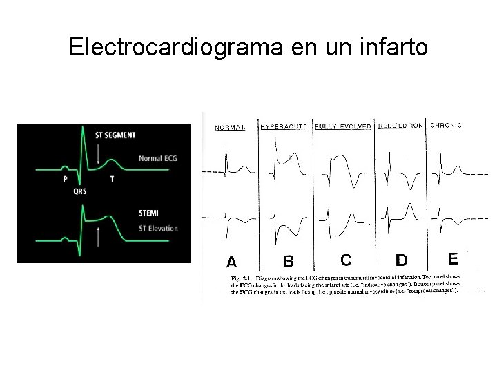 Electrocardiograma en un infarto 