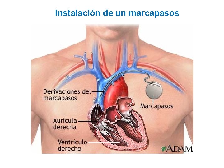 Instalación de un marcapasos 