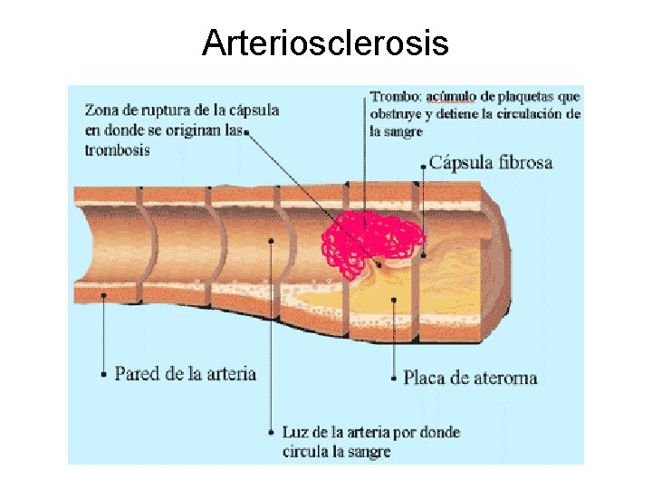 Arteriosclerosis 