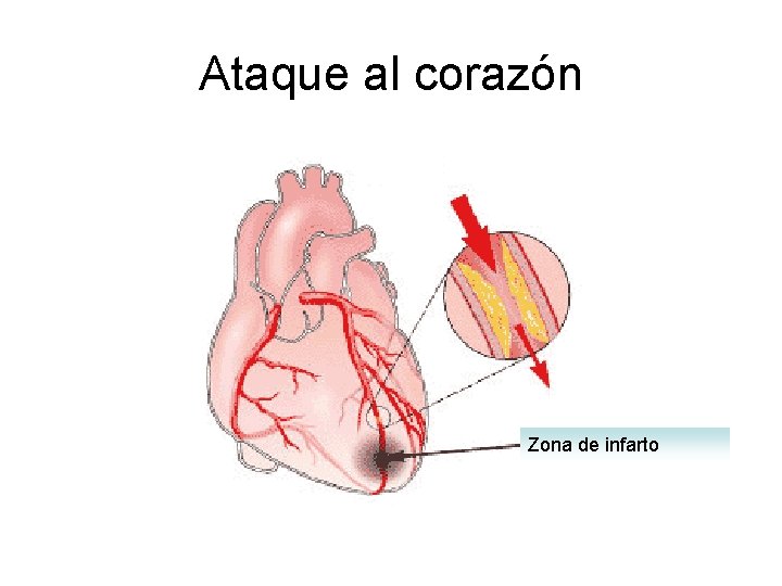 Ataque al corazón Zona de infarto 