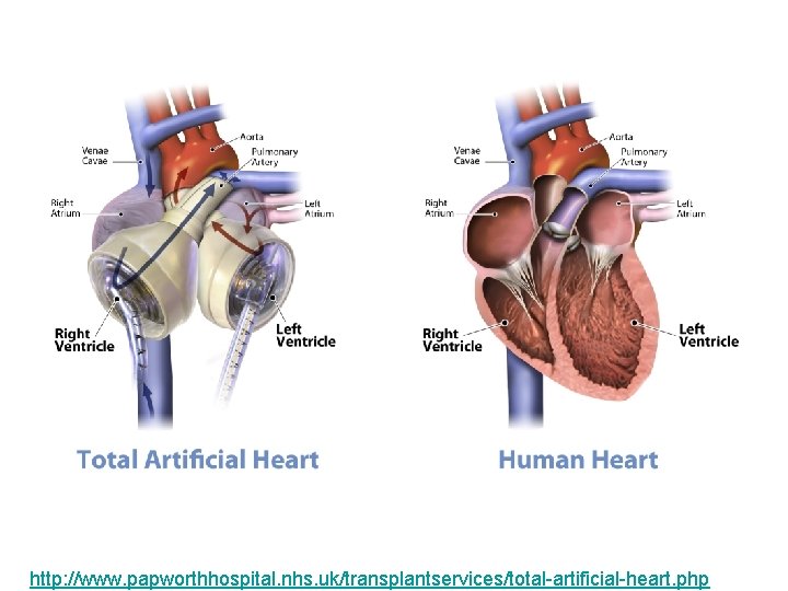 http: //www. papworthhospital. nhs. uk/transplantservices/total-artificial-heart. php 