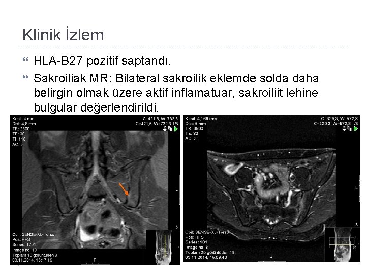 Klinik İzlem HLA-B 27 pozitif saptandı. Sakroiliak MR: Bilateral sakroilik eklemde solda daha belirgin
