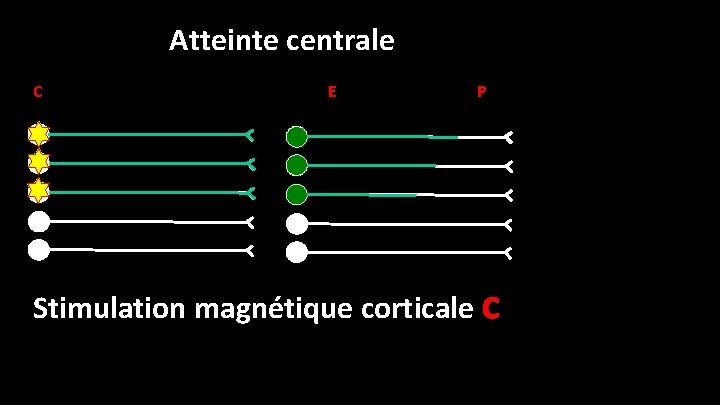 Atteinte centrale C E P Stimulation magnétique corticale C 